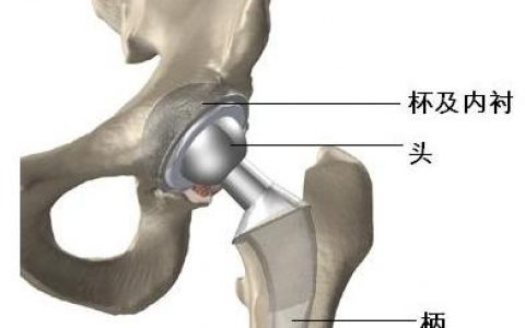 3D打印的跨界打劫之旅——盘点国内的经典临床应用