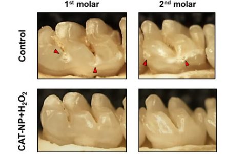 什么?!纳米粒子也能防蛀牙
